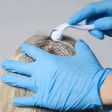 Derma roller treatment on the scalp