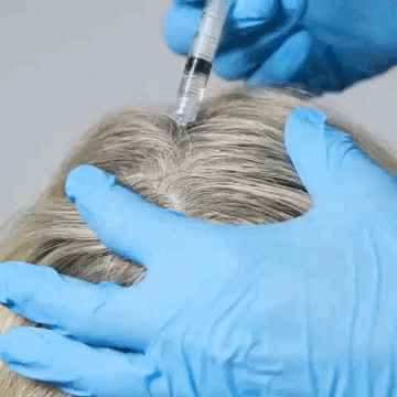 Hair Recovery Program SP55 applied to the scalp
