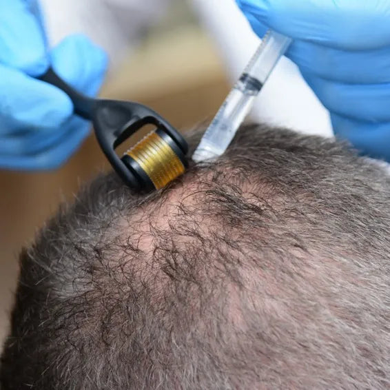 Hair Recovery Program SP55 applied in clinic