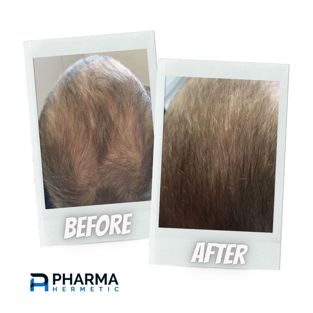hair recovery treatment before & after
