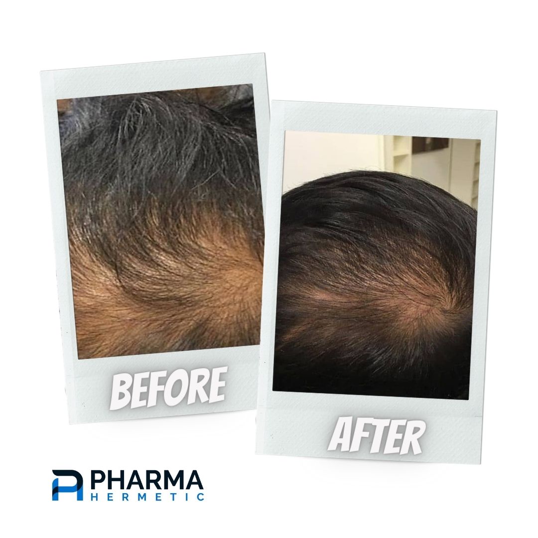 hair recovery treatment before & after